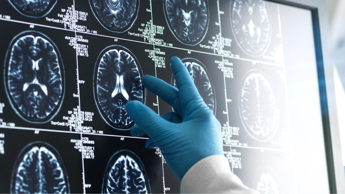 Study claims use of marijuana could lead to potential dementia diagnosis within the next 5 years