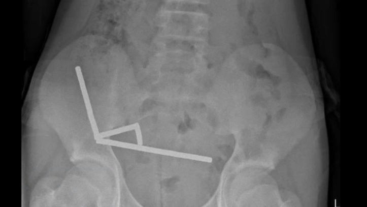 13-year-old boy forced to have part of his bowels removed after swallowing up to 100 magnets
