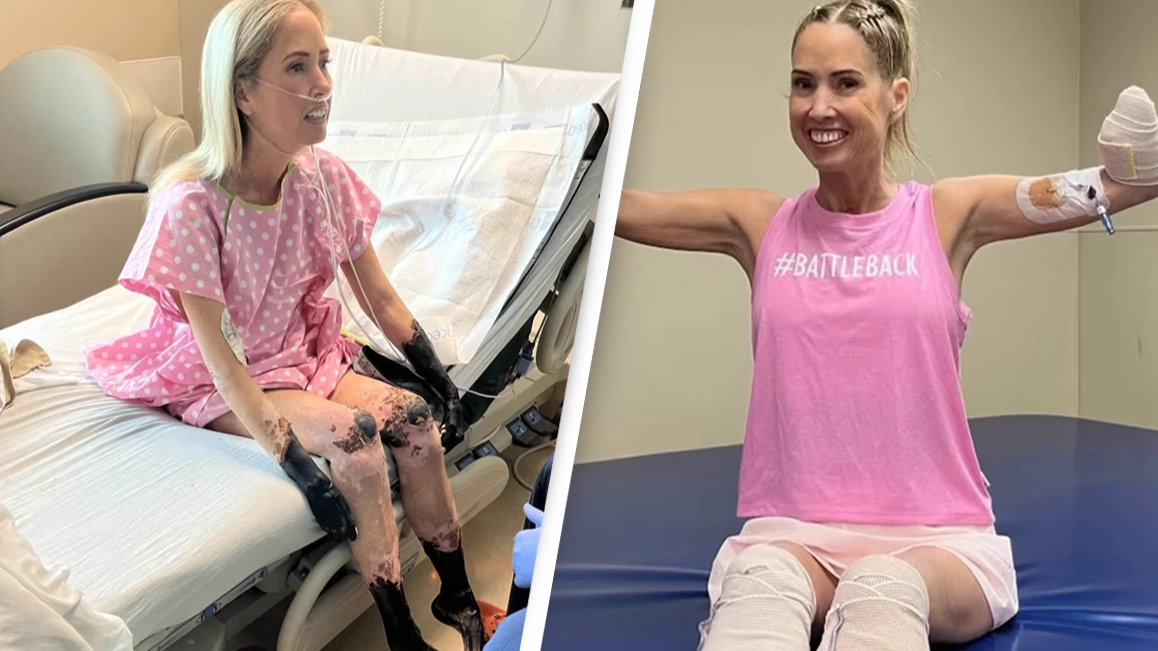 Woman who underwent quadruple amputation after her limbs ‘mummified’ thought she just had a cold