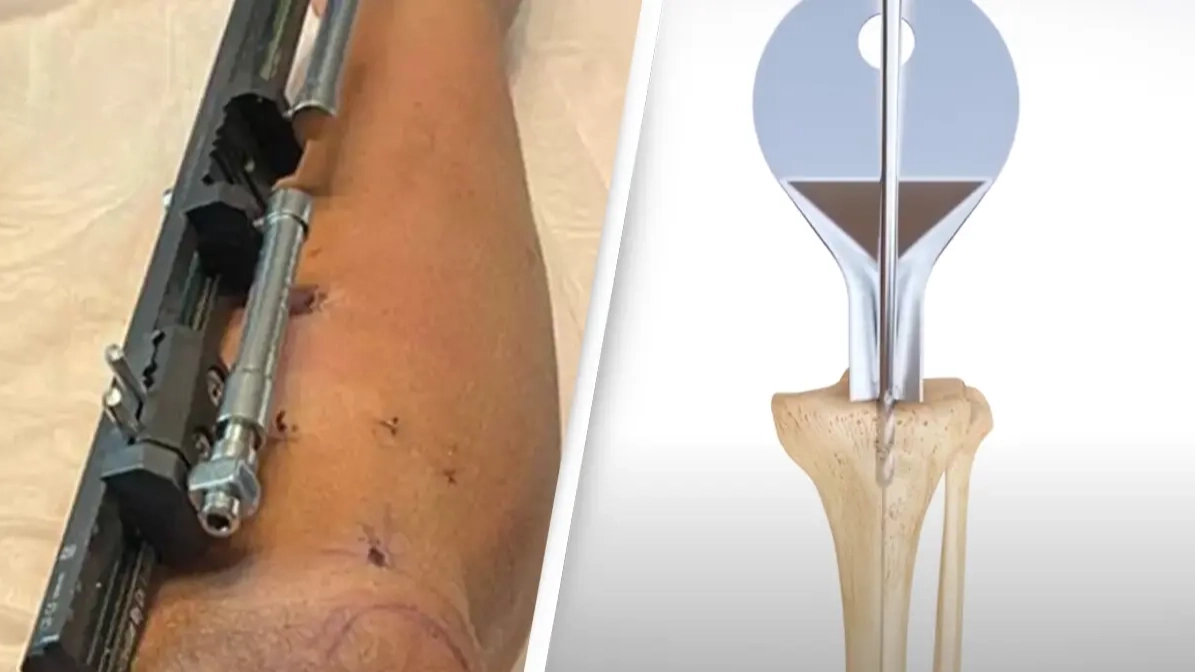 Disturbing simulation shows exactly how leg lengthening surgery works and people say it 'should be illegal'