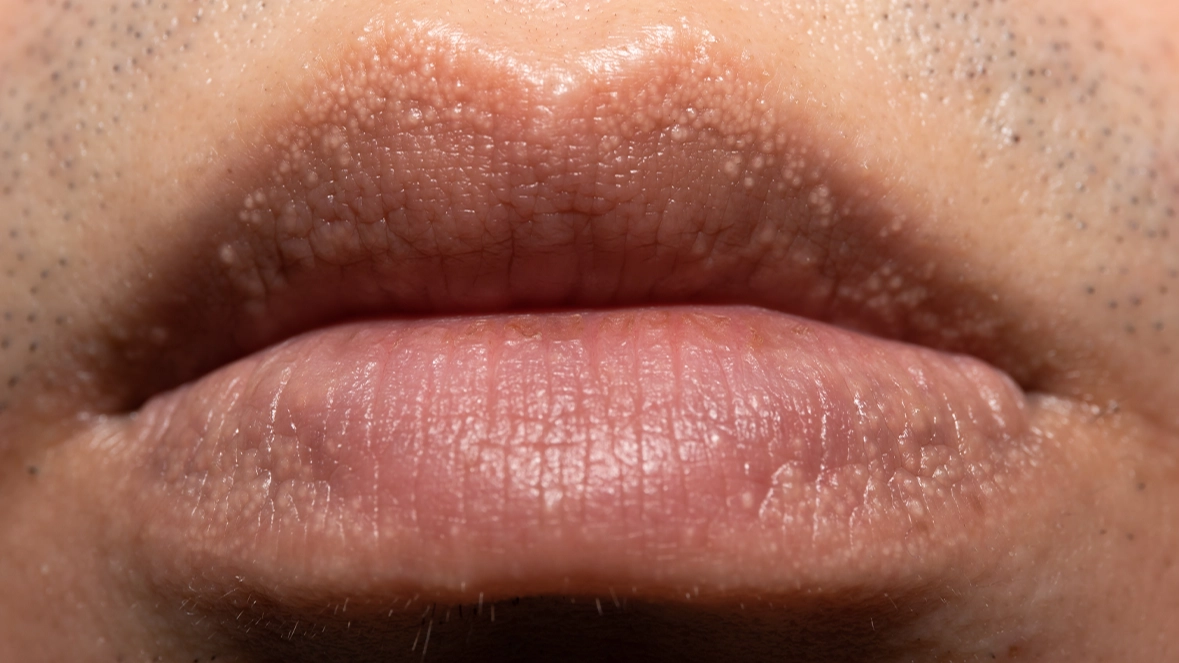 Reason people get unusual white bumps on their lips or private parts
