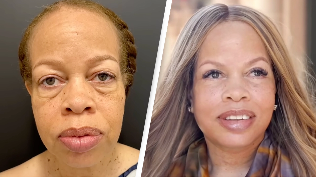Woman had an entire face rejuvenation and the before and after results are insane