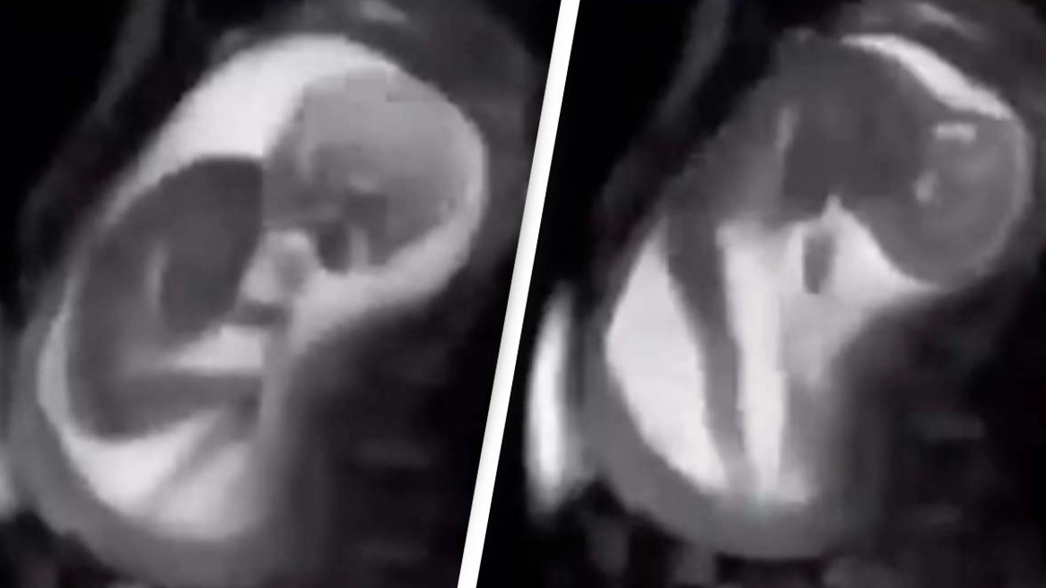 Unbelievably clear MRI footage shows baby ‘kicking the sh*t’ out of woman’s organs