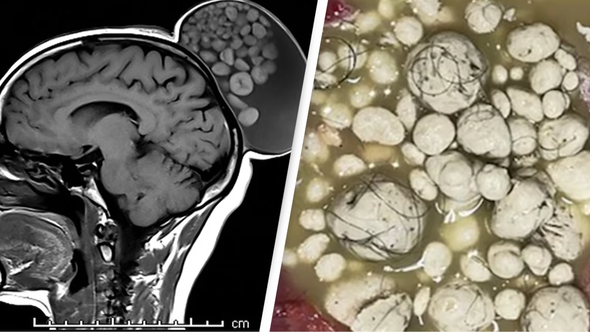 Shocking scans show cyst so large on woman’s head that doctors described it as a ‘sack of marbles’