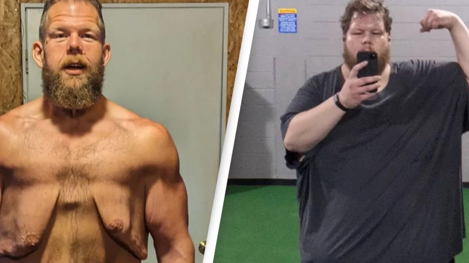 Man who lost nearly 400 pounds but is 'trapped' by his loose skin is close to reaching his next goal