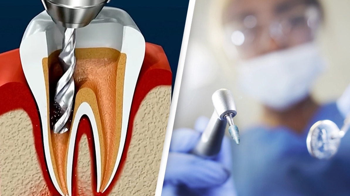 Detailed simulation of how a root canal works has people 'feeling the pain' just by watching