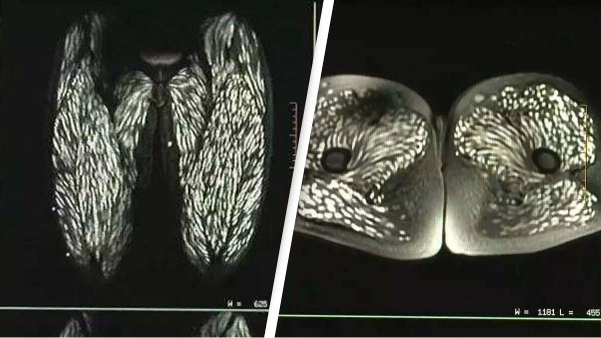 Horrifying scans show parasite-infested body of woman who'd been eating raw pork for 10 years