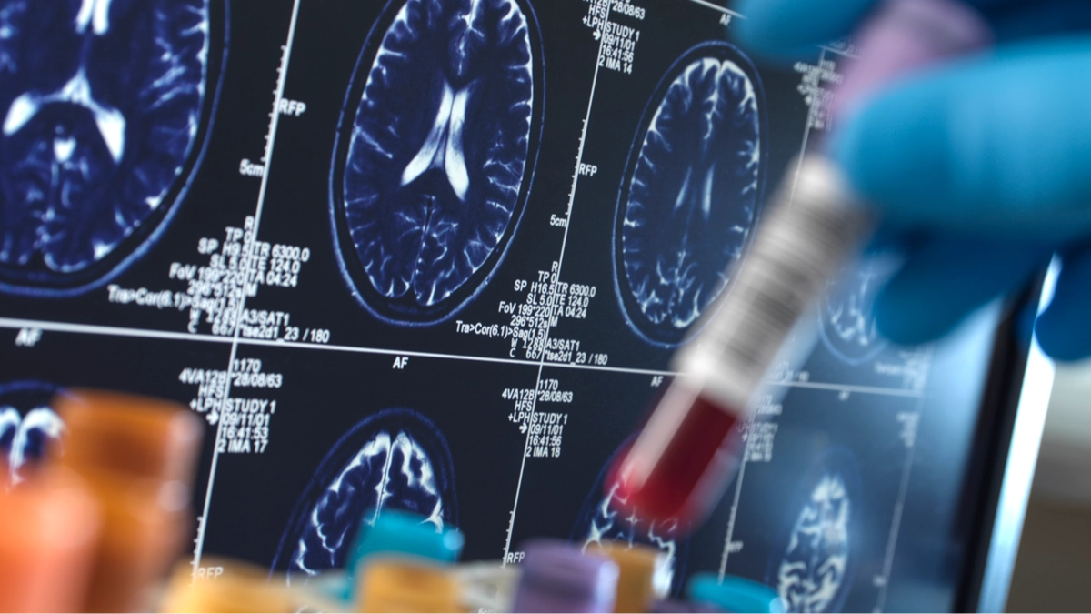 Study discovers the simple test that could predict your risk of developing Alzheimer's disease decades early