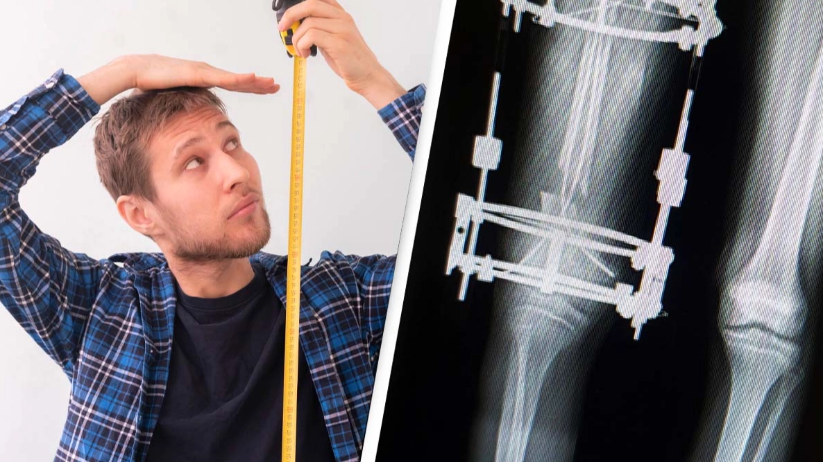 Man spends $75,000 to become 3 inches taller