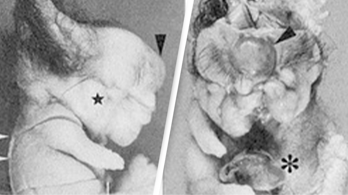 Horrifying scans show body parts and hair growing on rare tumor inside woman's body