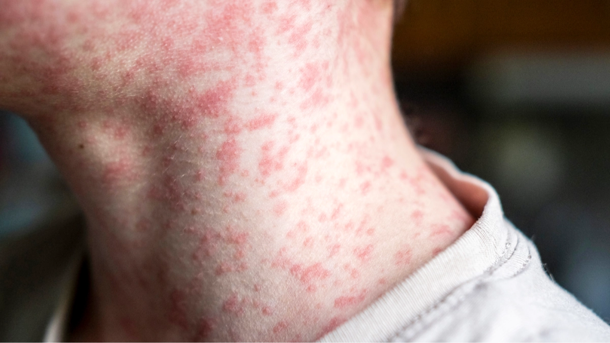 Urgent warning for US disease which just surpassed 2,000 cases for first time in 30 years