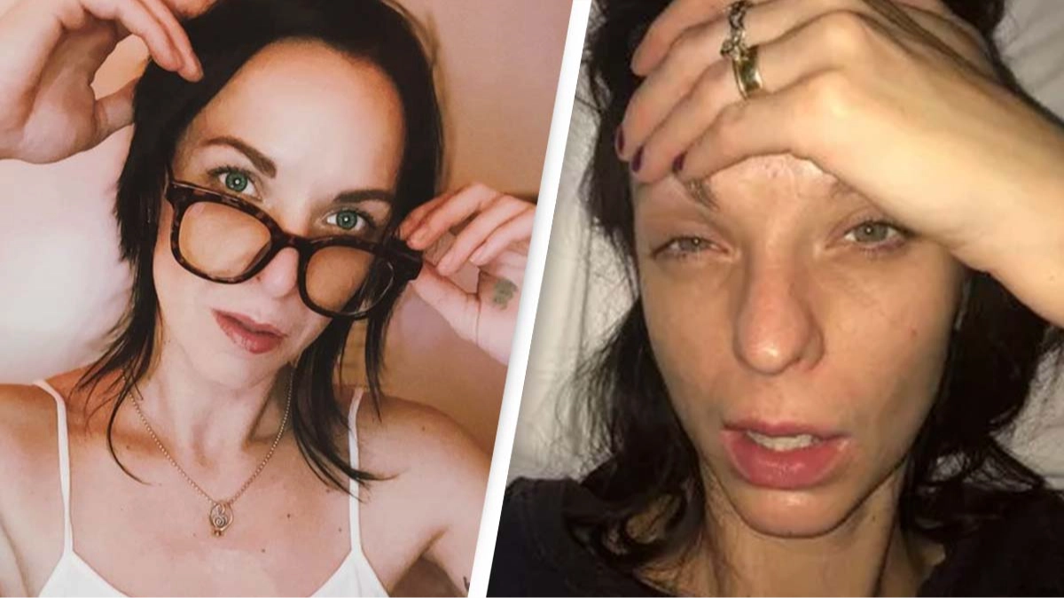 Woman who had yellow skin from alcohol addiction is unrecognizable after going sober