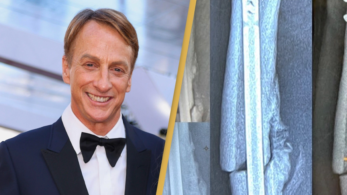 Tony Hawk gives painful update on future of skateboarding after breaking femur