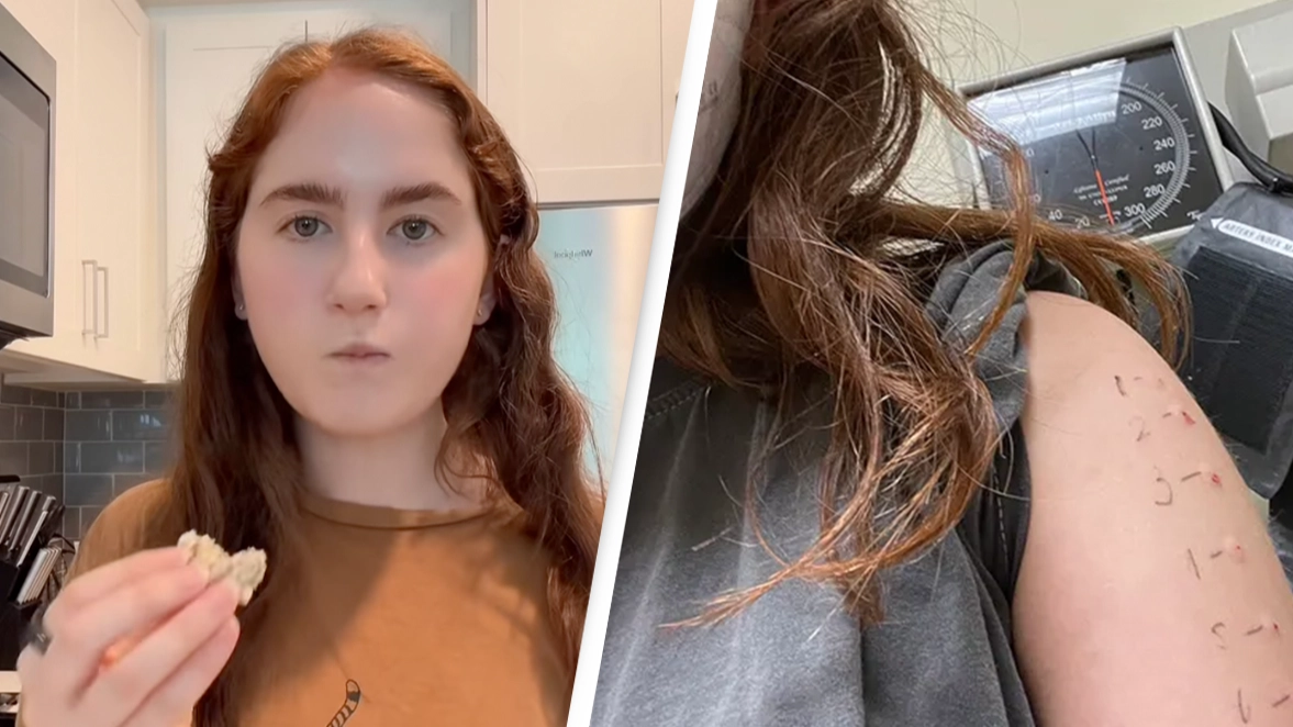 Woman limited to eating just 13 foods after discovering she has 100 different allergies