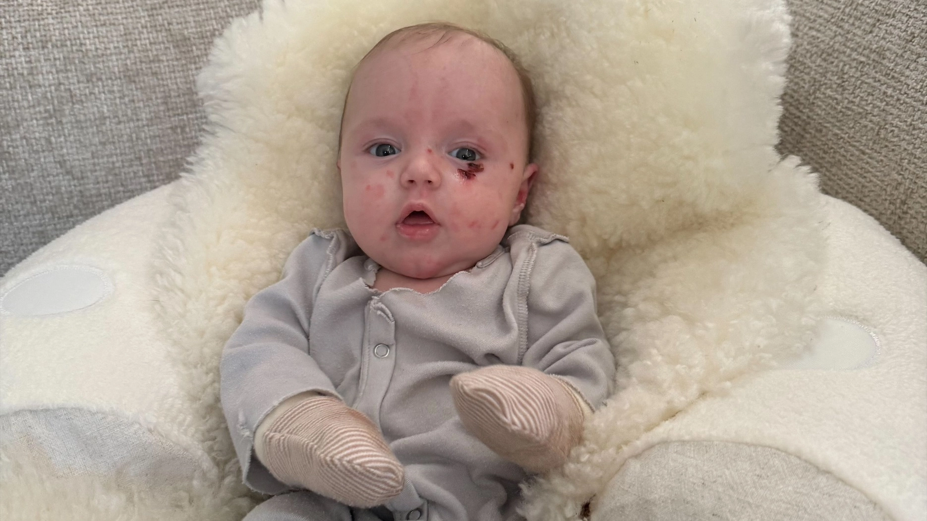 Mom who can't hold her baby because of rare ‘butterfly skin’ condition reveals first signs