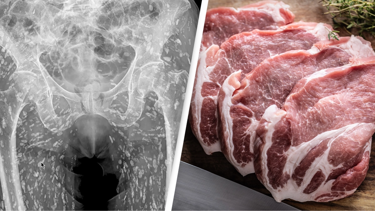 ER doctor breaks down horrifying scans that show parasite-infested body of person who ate raw pork