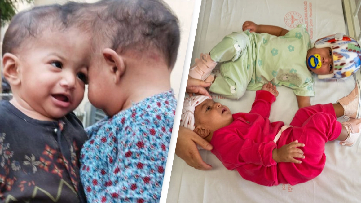 Conjoined twins have been successfully separated following groundbreaking 14-hour surgery using virtual reality