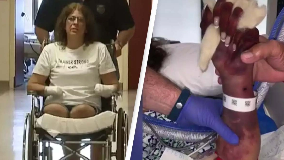 Mom lost all her limbs after she let her pet dog lick her