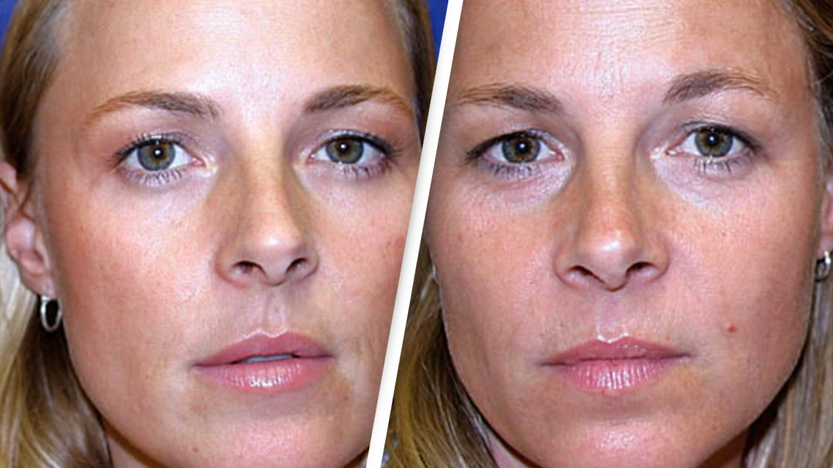 Identical twins share startling results after one used botox for 20 years while the other didn't