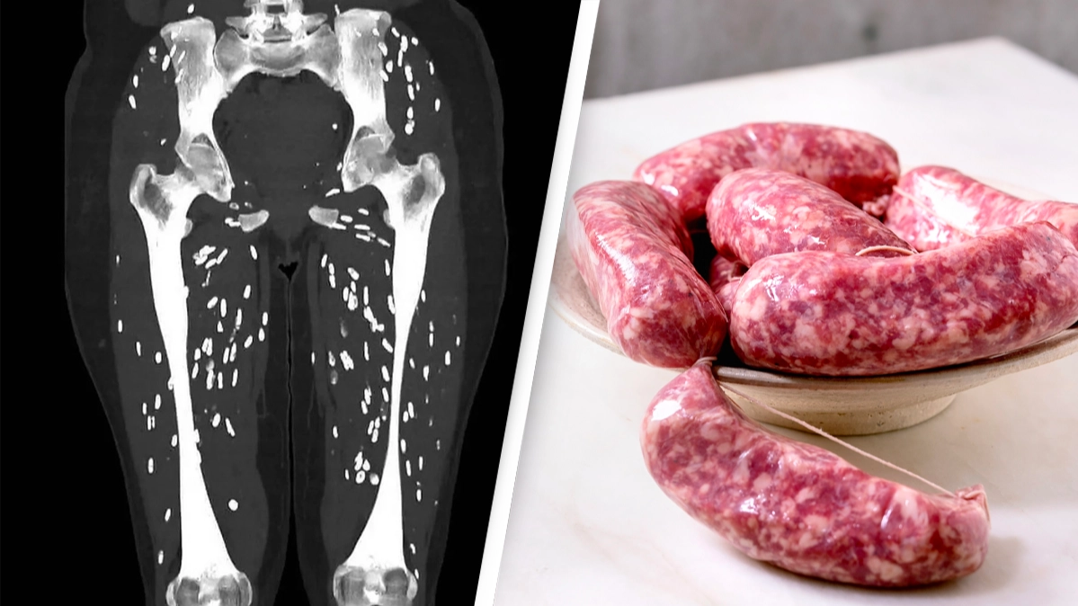 Traumatizing scan shows the horrifying effect of undercooking pork sausages and eating them