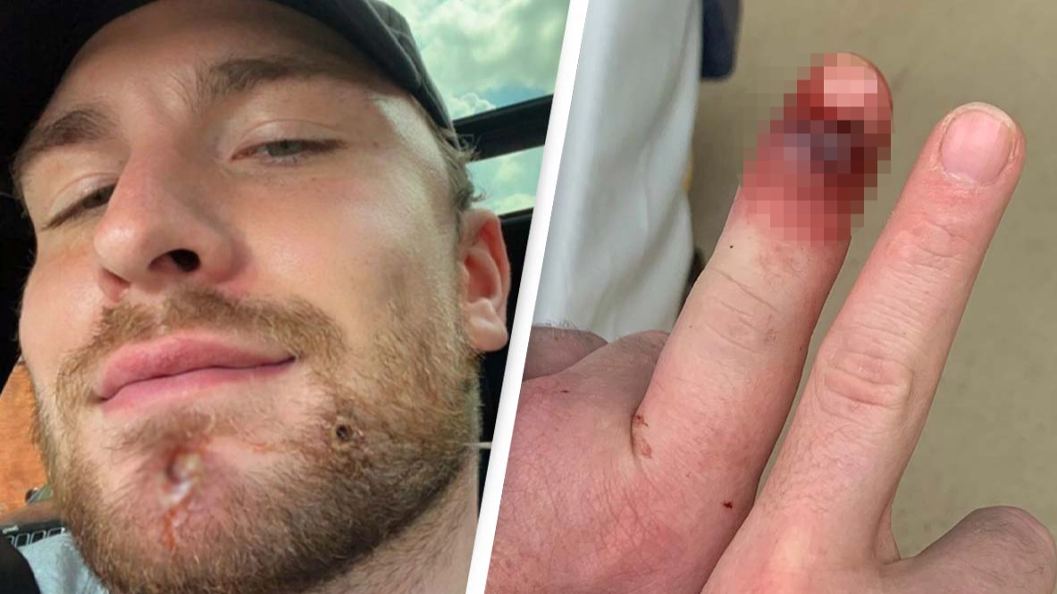Chicago Man Shares Horrific Monkeypox Symptoms As He Urges People To Get Vaccinated