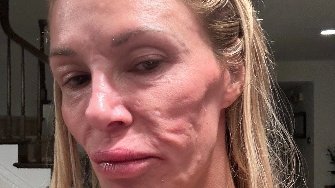 Brandi Glanville's surgery to have 'face taken off' and 'power washed' explained