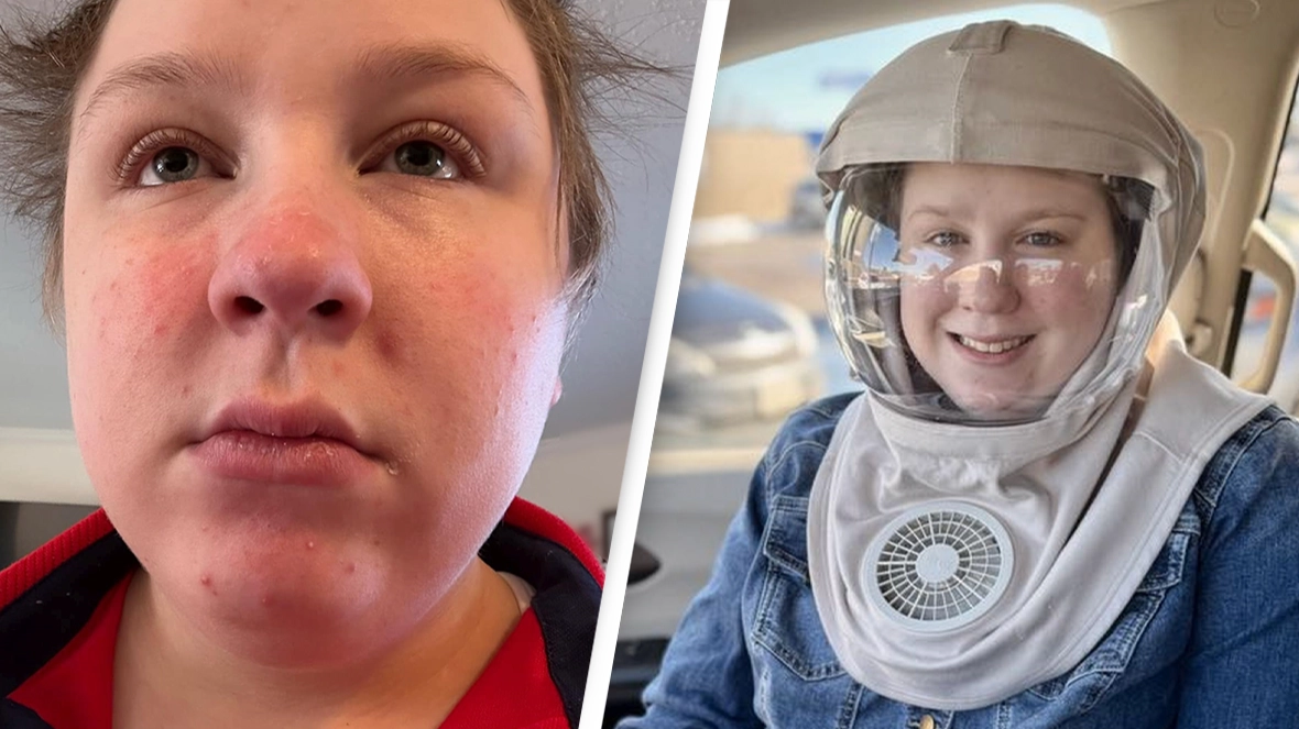 Woman who has to hide from sun and cover every part of her body opens up about living with life-changing condition