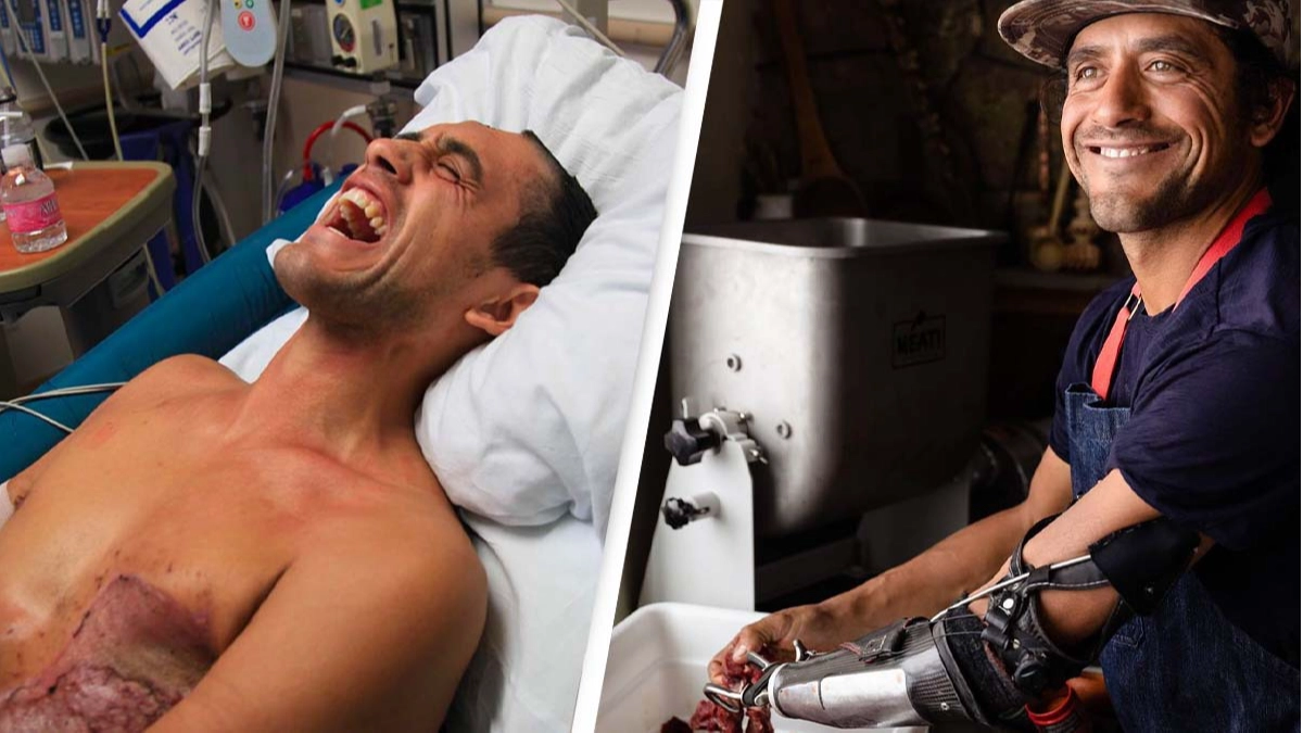 Incredible Story Of ‘Bionic Chef’ Who Was Electrocuted By A Black Bear