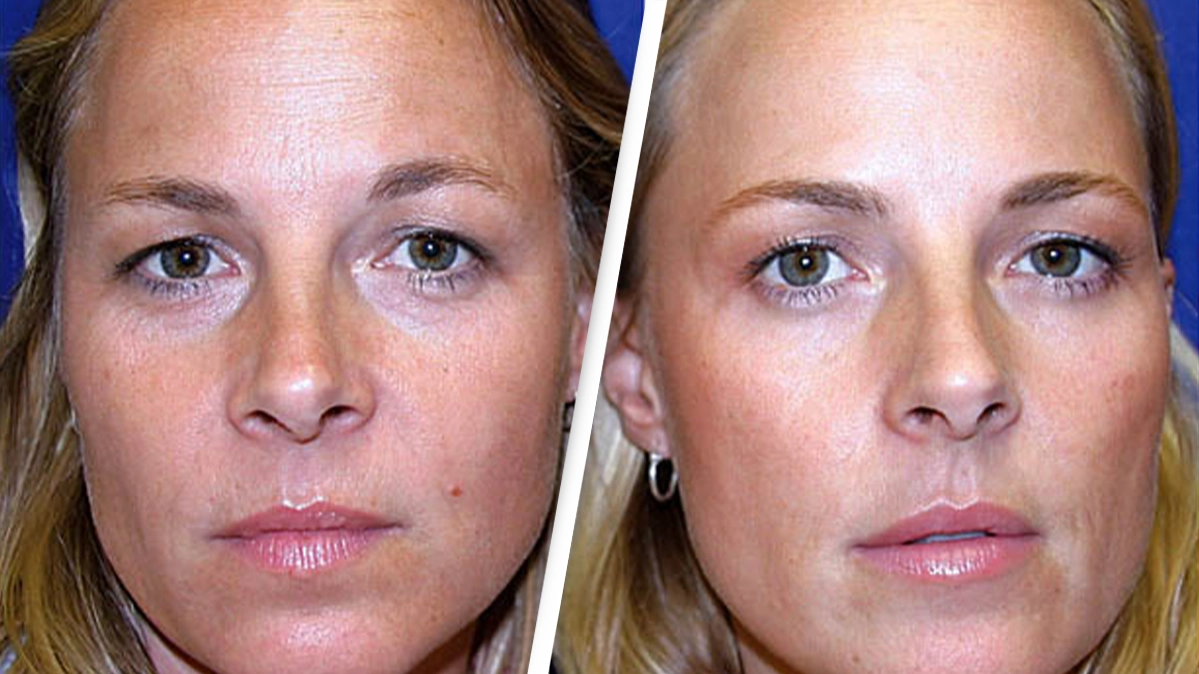 Doctor explains long-term effects as identical twins share startling results after one used botox while the other didn't