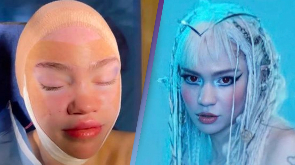 Grimes shares post-surgery photo and says she's done 'something crazy'