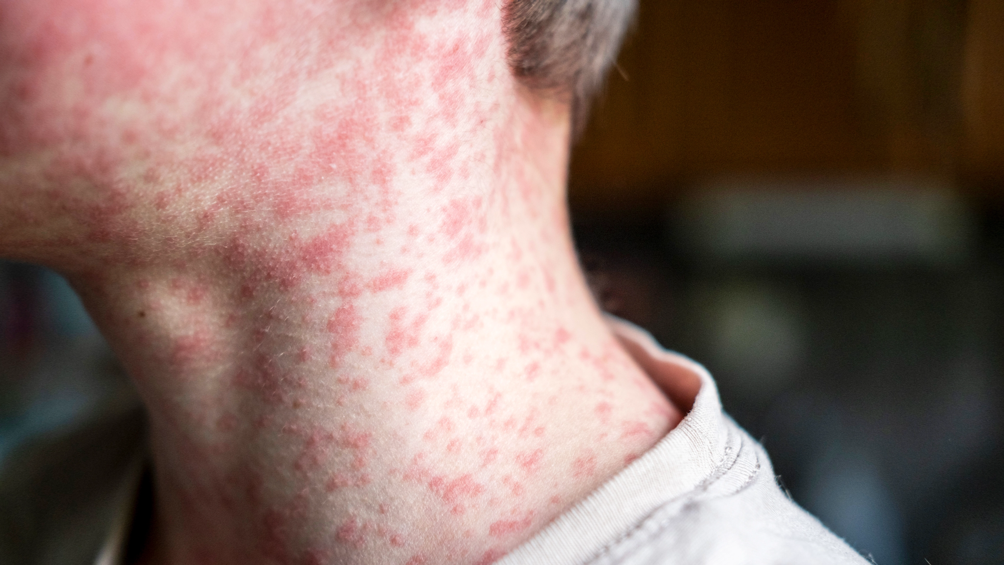 Everything to know about US measles outbreak as 2025 cases so far surpass numbers for whole of 2024