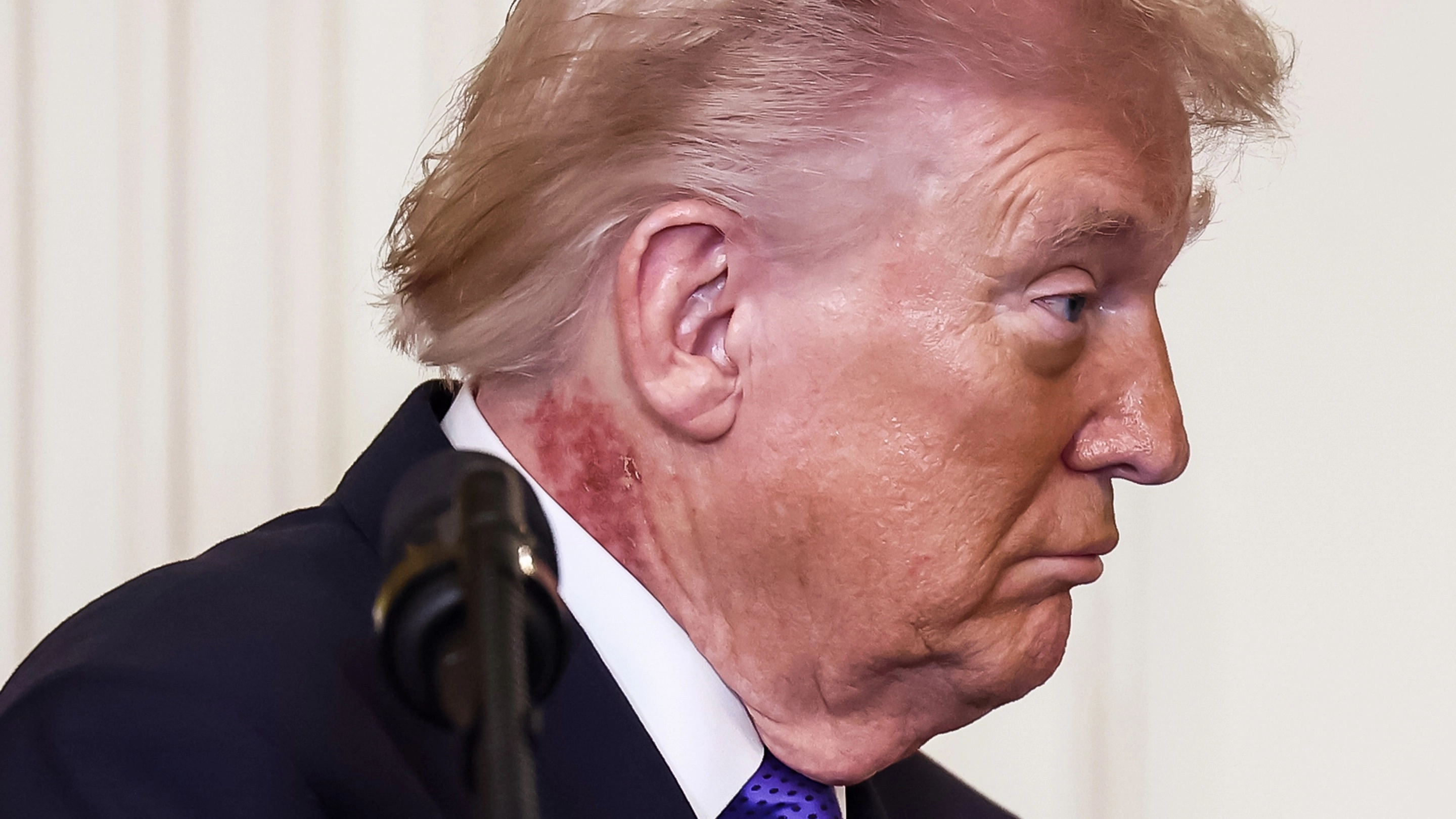 Donald Trump sparks fresh health concerns with scabbing neck rash