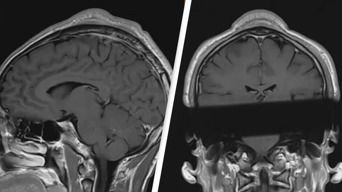 Man's terrifying head scan shows 'tumor' he got from doing common dance move