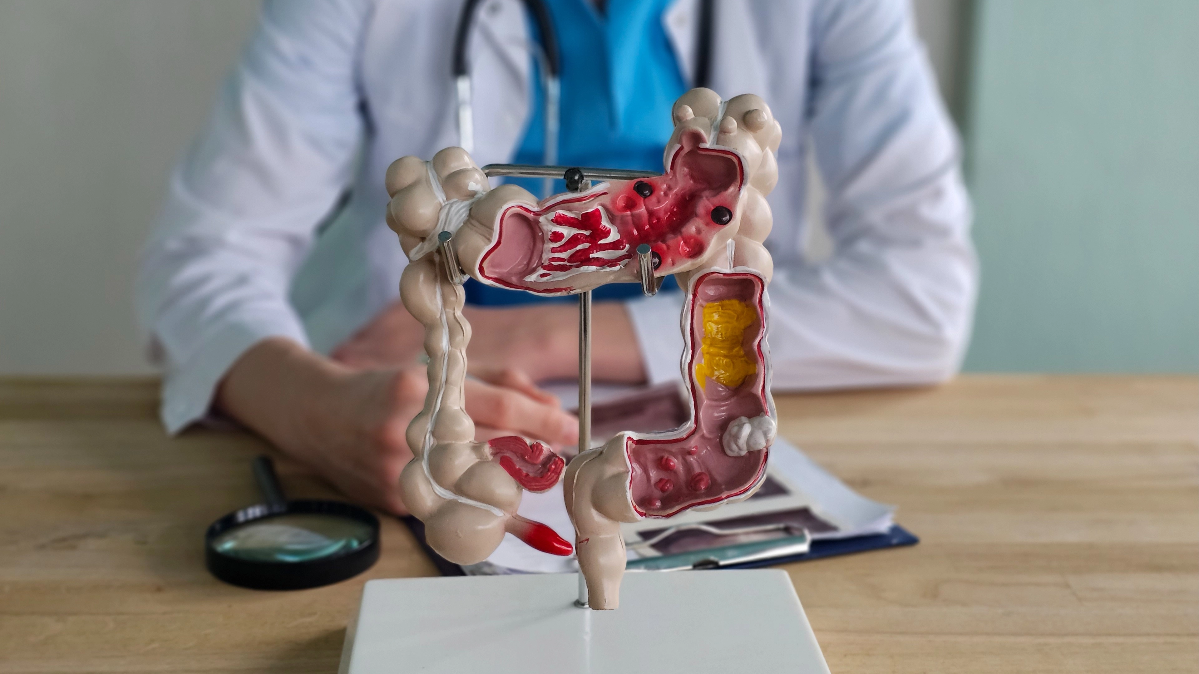 Scientists reveal how colon cancer is only type of cancer where deaths are increasing for people under 50