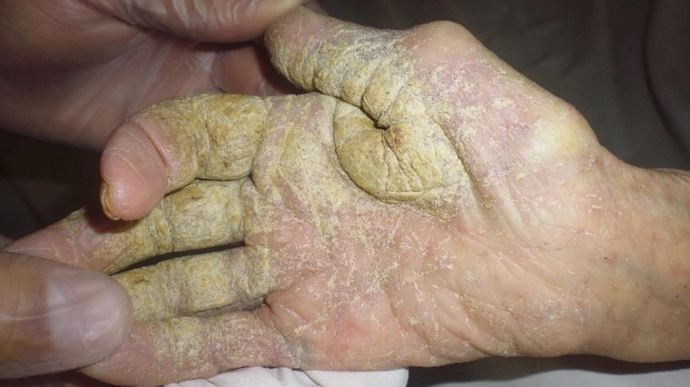 Medieval skin disease outbreak in the UK leaves patients’ skin ‘crawling’