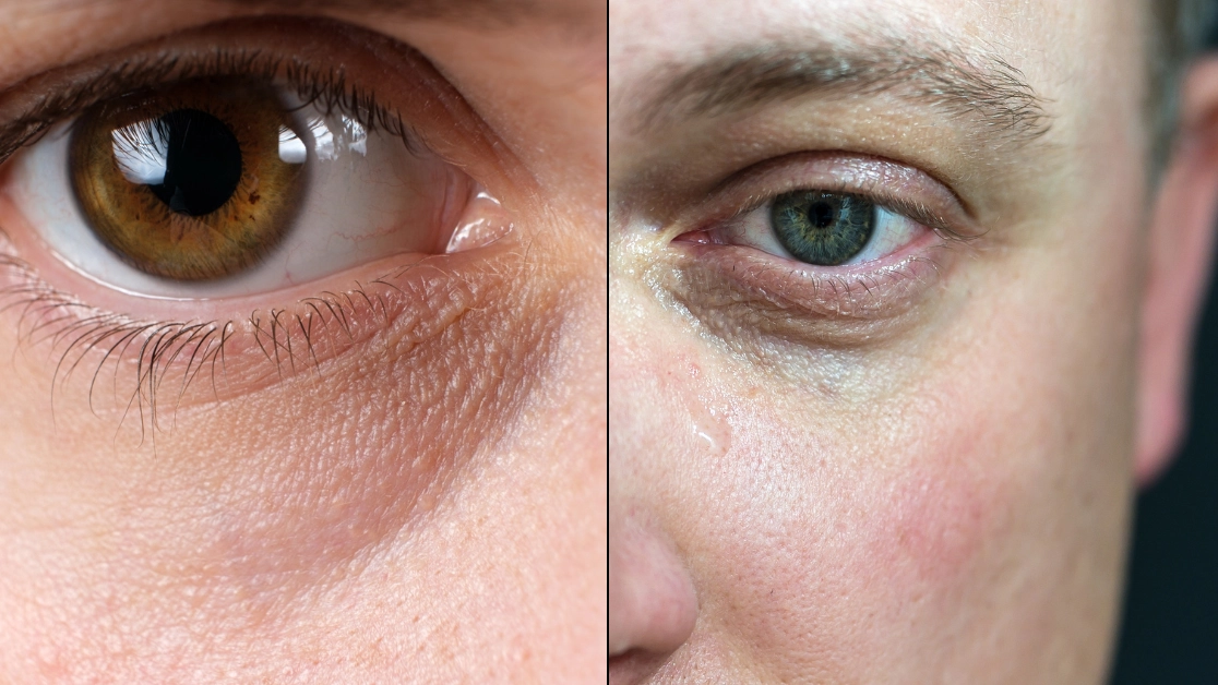 People commonly put dark circles around eyes down to tiredness but it's not the only cause