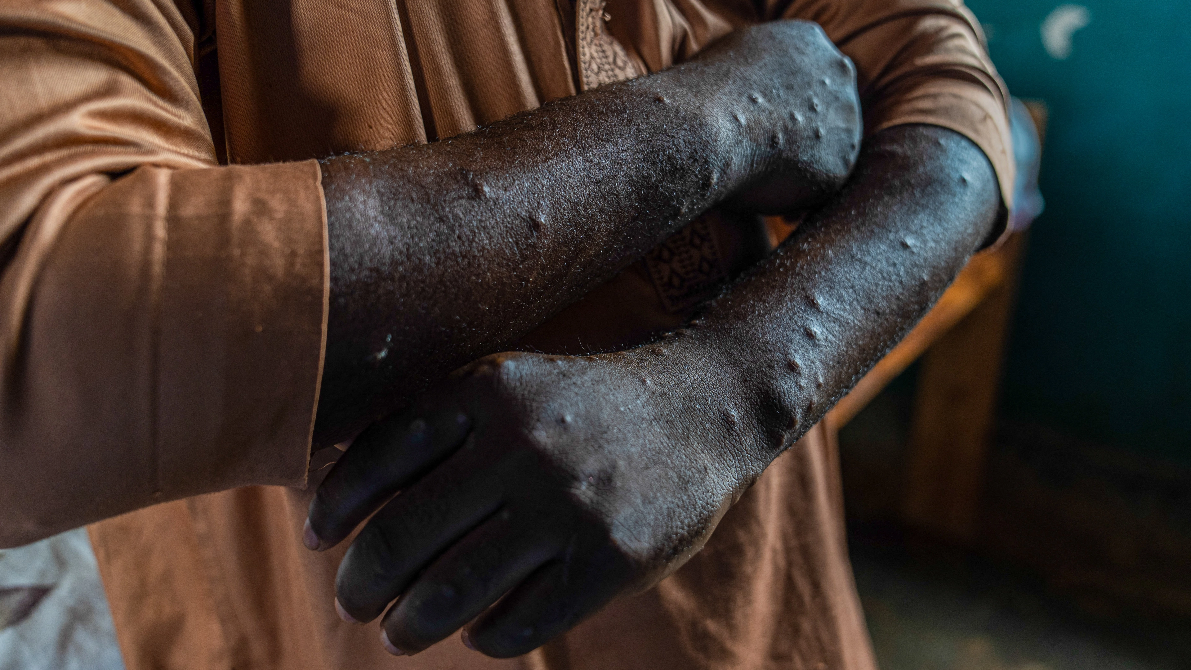 Symptoms of mpox explained as new strain is identified in England