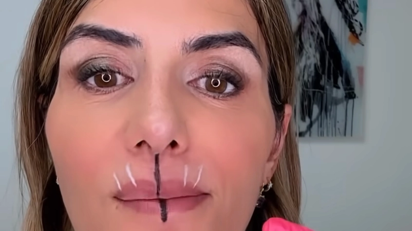 Doctor only injects one half of her lips with botox to show difference after two weeks