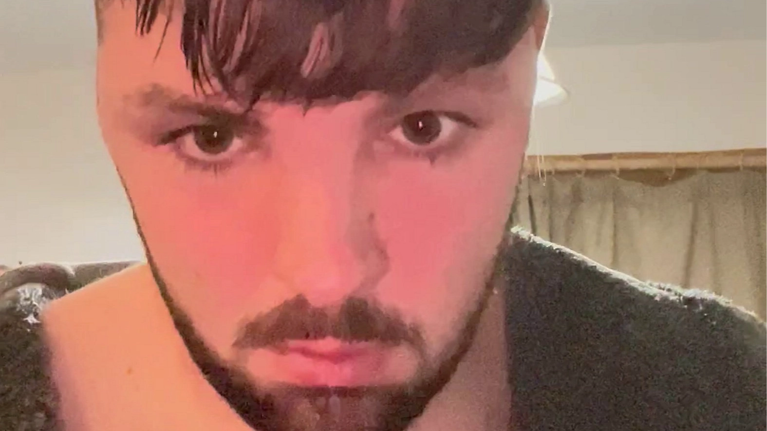 Lad reveals shocking consequences after he ignored no sex rule after Turkey hair transplant