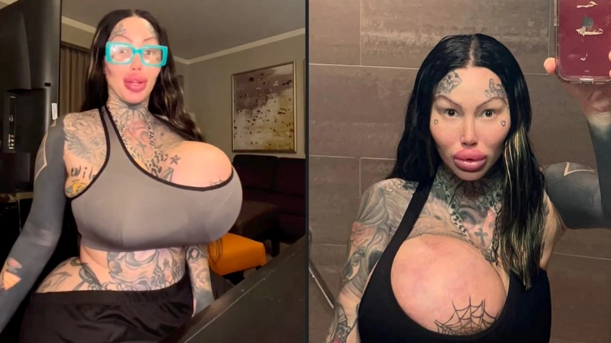 Instagram model left with huge 'uniboob' after one of her implants exploded