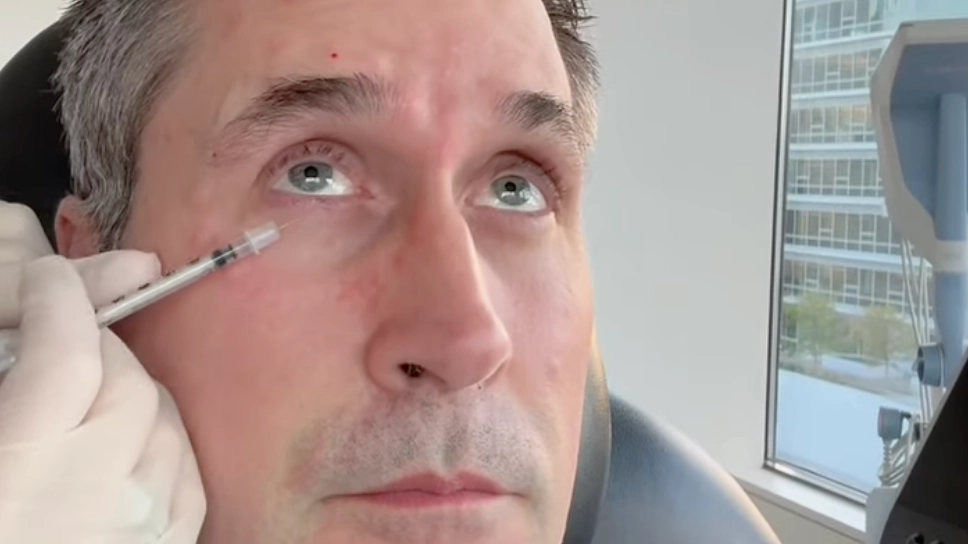 Doctor injects half her husband's face with Botox to show difference