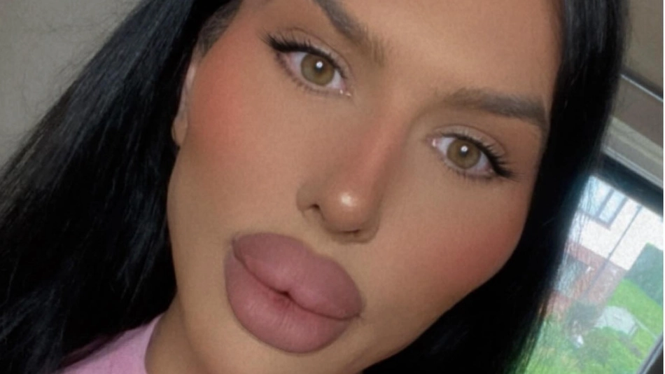 Woman with ‘UK’s biggest lips’ has filler dissolved to show off difference