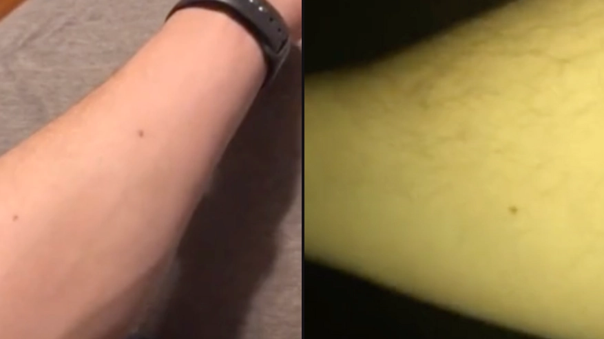 Man claims to have found freckle on body that all blokes have