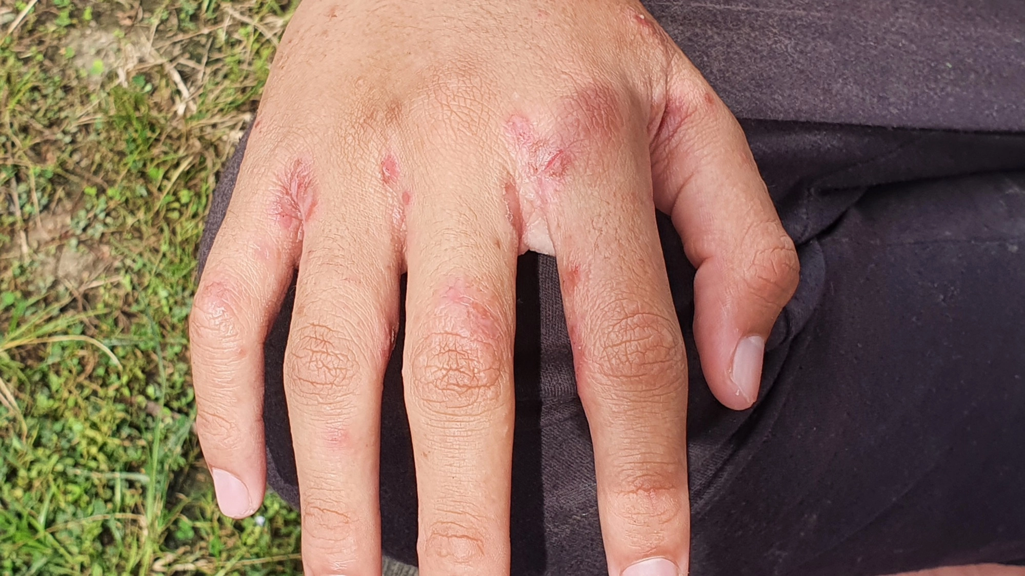 Key signs of brutal Victorian disease as cases surge throughout UK
