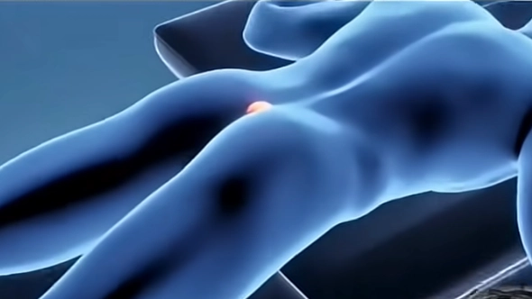 Gruesome simulation shows 'most painful condition' that affects people with a hairy bottom