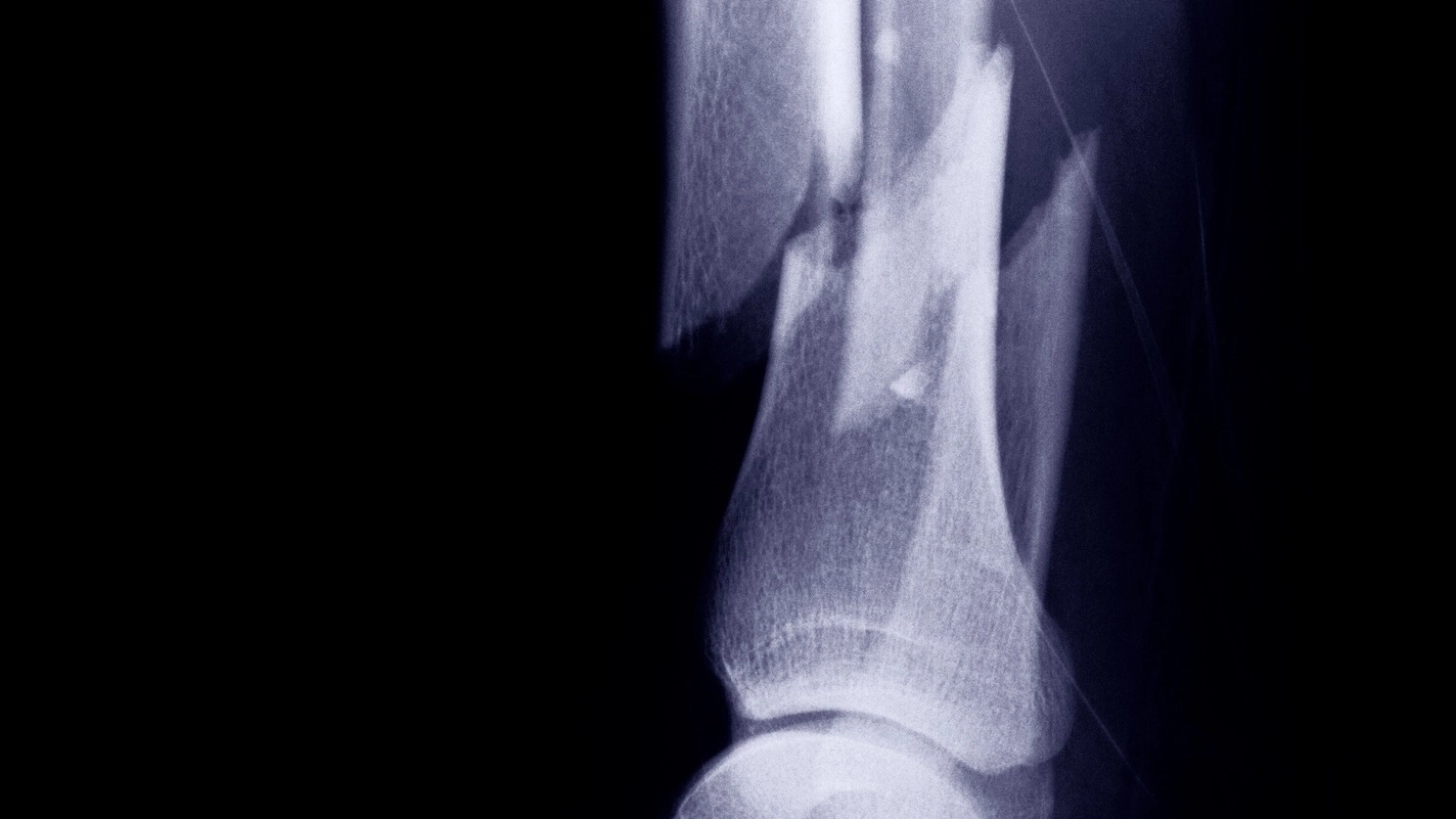 People most likely to break a bone following viral theory about anyone who hasn’t