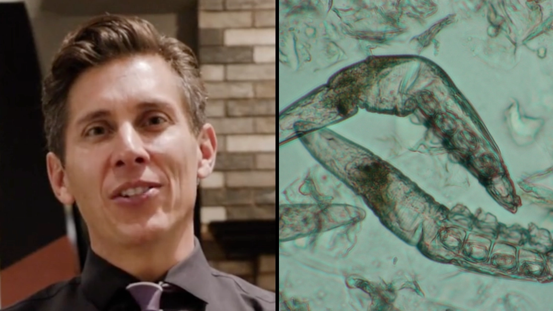 Doctor warns over parasitic eye infection caught by common act that millions do