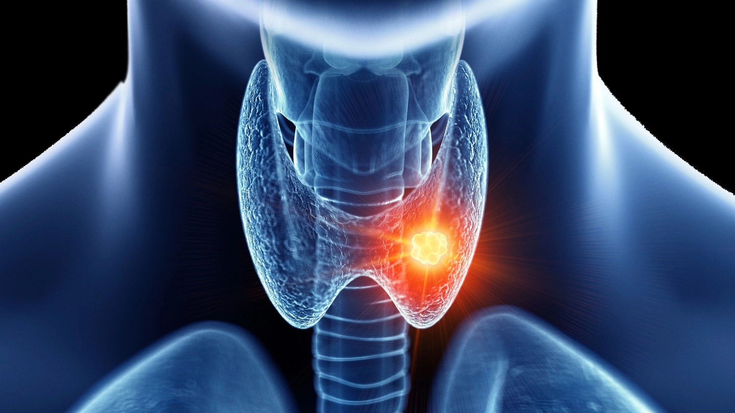 Signs and symptoms of oral sex-related throat cancer that can appear decades later