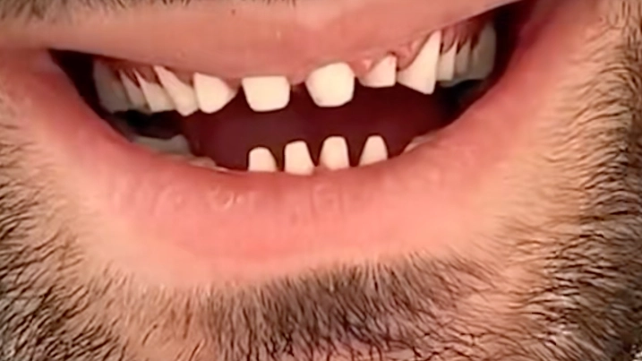 Dentist exposes the dark side of people going for 'Turkey teeth'