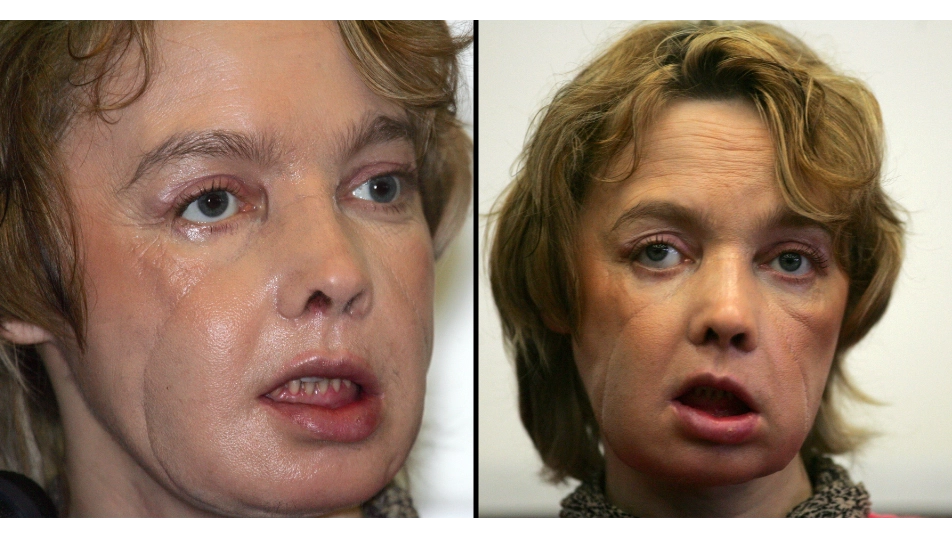 Woman who got world’s first face transplant suffered devastating consequences afterwards